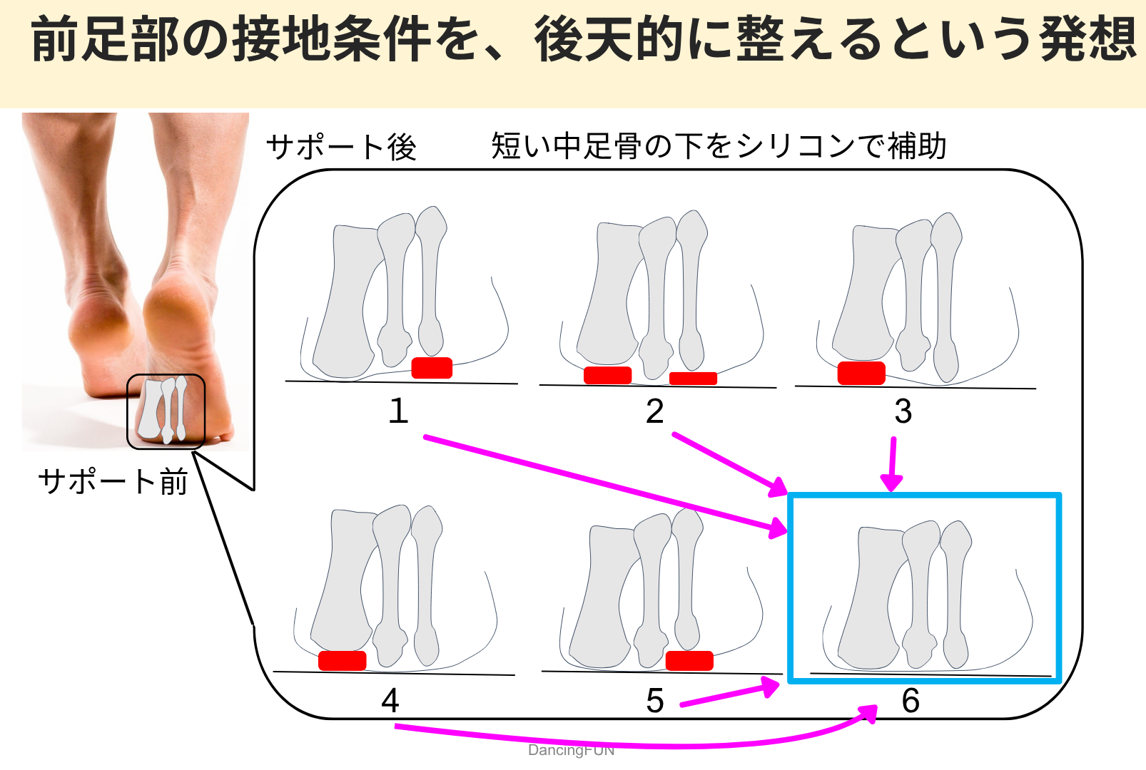 前足部の接地条件を整える考え方